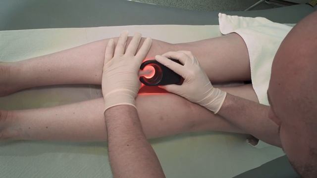 Удаление сосудов лазером Cutera XE смотреть онлайн