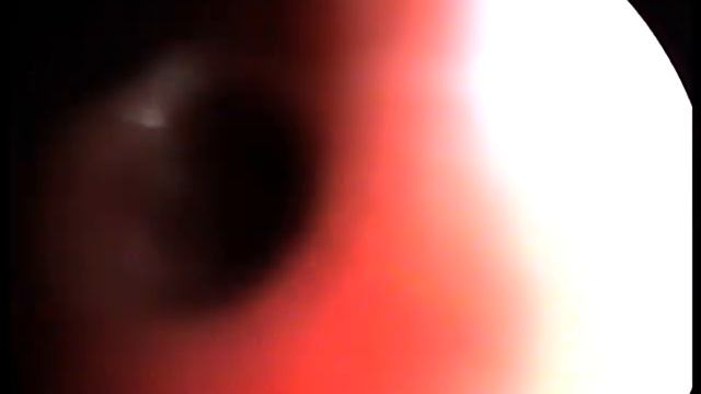 Bronchoscopy:the collapse of the trachea and bronchi.Трахеобронхоскопия. смотреть онлайн