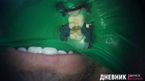 лечение кариеса 46 47 зуба постановка пломбы #стоматология #кариес #пломба #стоматолог #имплант