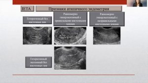УЗИ при неопластических процессах эндометрия. Проф. Гажонова. В.Е.