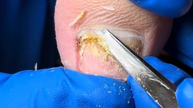 La uña del pie es como una hermosa piedra de jade, limpia el pus profundo. смотреть онлайн