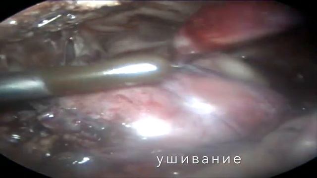 Разрыв мочевого пузыря у собаки, лапароскопическое ушивание смотреть онлайн