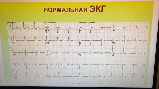 ЭКГ қазақша. Кіріспе сабақ. 2-бөлім #экгқазақша#экгказакша/медицина смотреть онлайн