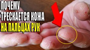 Почему трескается кожа на пальцах рук