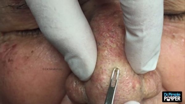 The Nose Knows: Part I "Mr. Wilson's" Blackhead Extractions