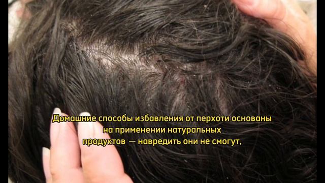 Как избавиться от перхоти в домашних условия: средства, советы, лайфхаки смотреть онлайн