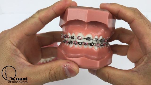 Ceramic Braces vs Metal Braces смотреть онлайн