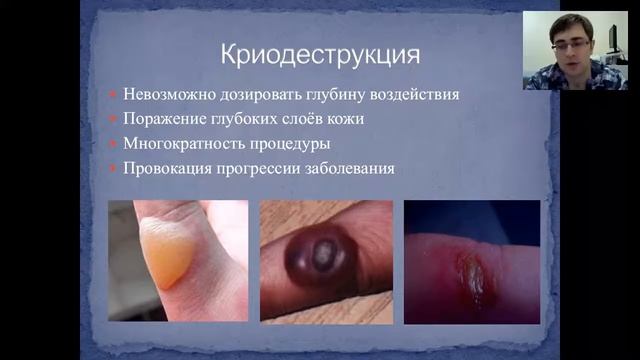 ВПЧ-инфекция и остроконечные кондиломы, вебинар 15.05.2015 смотреть онлайн
