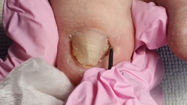 Вросший ноготь. Как вылечить вросший ноготь.