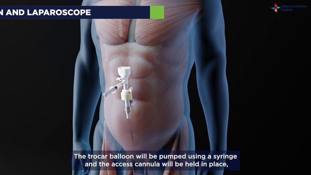 Laparoscopic Total Extraperitoneal (TEP) Inguinal Hernia Repair Surgery - Explained