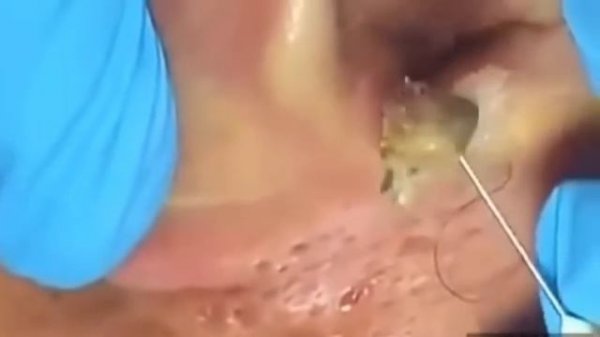 # 5 ШОООК Большая черная точка\КАМЕДОН\Большой жировик\удаление черноголовых