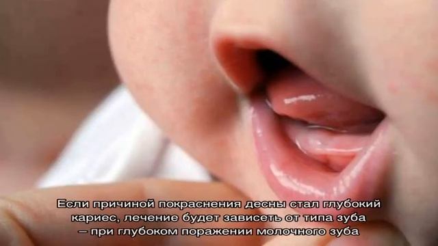 Красные десны у ребенка смотреть онлайн