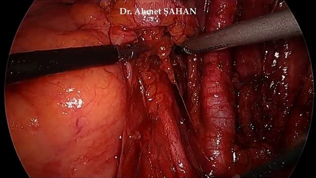 Laparoscopic pelvic lymph node dissection (Laparoscopic radical prostatectomy); Dr. Ahmet ŞAHAN смотреть онлайн