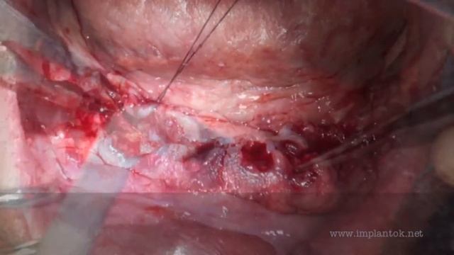 Dental Implant Surgery: Teeth in a Day Branemark system Nobel biocare смотреть онлайн
