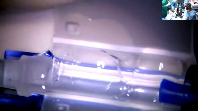 Aurovue EV Toric IOL Implantation Using HummingbirdLite Phaco Machine смотреть онлайн