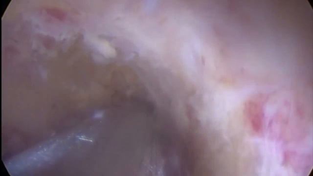 Плацентарный полип. Удаление шейвером. смотреть онлайн