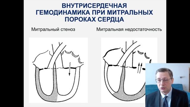 Видеолекция "ОРЛ. Митральные пороки сердца" (доцент Д.А.Царегородцев) смотреть онлайн