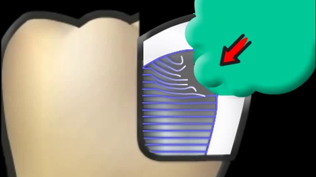 Бондинг заполнение зуб (Керамическая декор) 