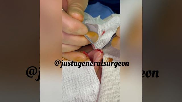 Inside the OR with @justageneralsurgeon - excision of pesky lip mass mucocele scar surgery surgeon смотреть онлайн