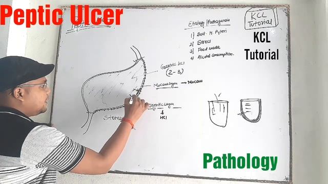 Peptic Ulcer | Disorder of GIT || L-6 Unit-3 | Pathology 2nd Sem смотреть онлайн