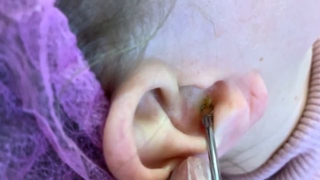 blackhead extraction | removing cystic acne | чёрные точки | прыщи выдавливание| акне смотреть онлайн