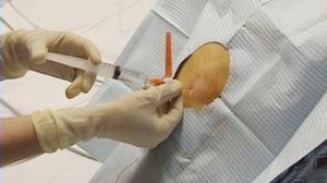 Плевральная пункция