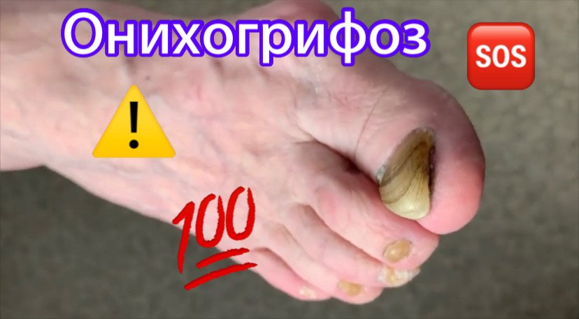 Онихогрифоз⚠️?❗️ • Зачистка✅ смотреть онлайн