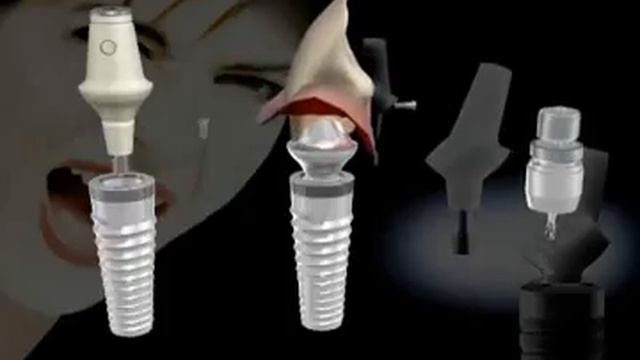 Zahnimplantat System Ankylos смотреть онлайн