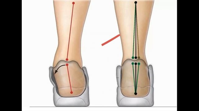 ПЛОСКОСТОПИЕ/ПРИЧИНЫ ДИАГНОСТИКА И ЛЕЧЕНИЕ
