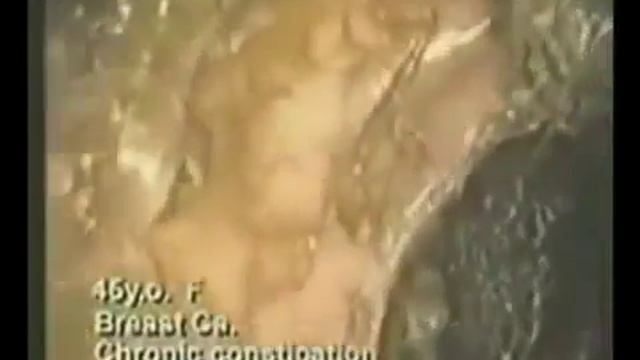 Здоровье зависит от чистоты нашего кишечника. смотреть онлайн