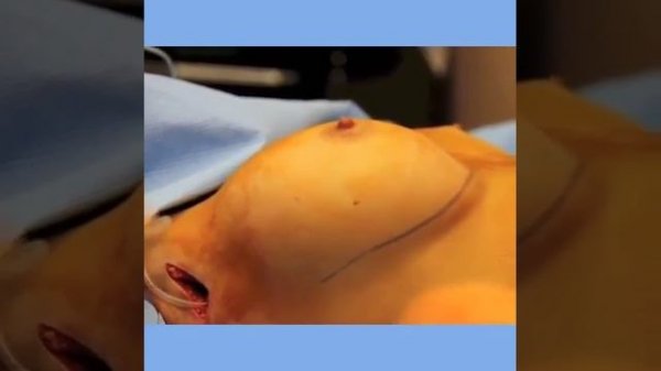 Пластика груди. Увеличение груди. Казарян Тигран Владимирович ПЛАСТИЧЕСКИЙ ХИРУРГ