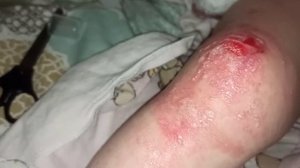 Шок! Повязка и бинт прилипли к ране. Не грамотно сделанная повязка. Буллезный эпидермолиз.