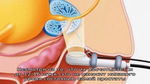 Задачи биопсии простаты и правила ее проведения