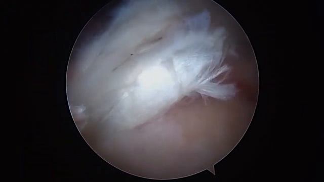 L Suprapectoral Biceps Tenodesis And Rotator Cuff Repair 1.24.22 RD