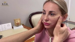 Подтяжка нижней и средней третей лица (SMAS - лифтинг).