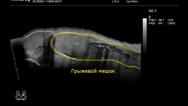 Пахово-мошоночная грыжа смотреть онлайн