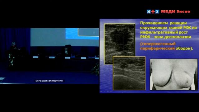 Лекция "Эхографическая диагностика опухолей молочной железы" смотреть онлайн