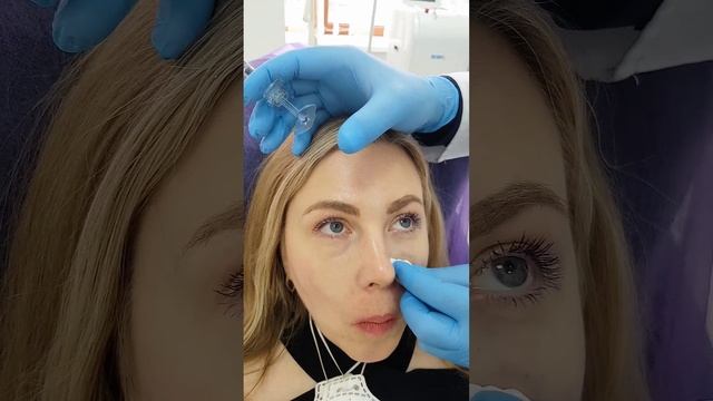 Коррекция обьема средней трети щеки филлерами Stylage. смотреть онлайн