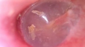 Эндоскопия левого уха. нормальная барабанная перепонка.