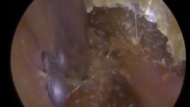 Извлечение огромного куска ушной серы из уха | Часть 3 смотреть онлайн