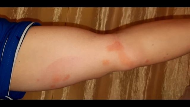 Как выглядят укусы клопов смотреть онлайн