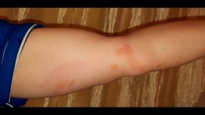 Как выглядят укусы клопов