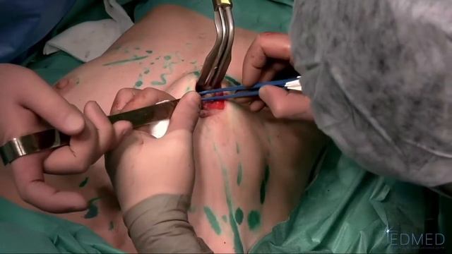 Мастер-класс: гемостаз при аугментационной маммопластике