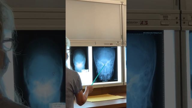 Skull X-ray clinical notations How to perform PA Caldwell, lateral, AP Townes, SMV submentovertical смотреть онлайн