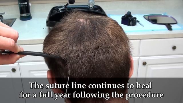 Dr. Brett Bolton Scar Video Hair Transplant смотреть онлайн
