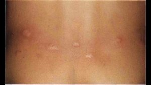 как выглядят укусы постельных клещей