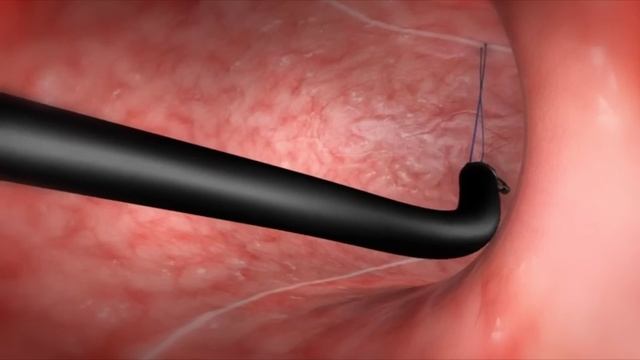 What Happens During the Endoscopic Sleeve Gastroplasty (ESG) Procedure? смотреть онлайн