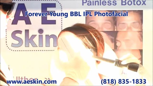 Forever Young BBL IPL Photofacial Demonstration 15 - A E Skin - Encino, CA - 818-835-1833 смотреть онлайн