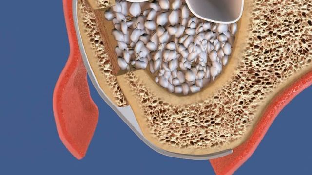 Костный блок и поднятие синуса Открытый синус лифтинг и букальный костный блок смотреть онлайн
