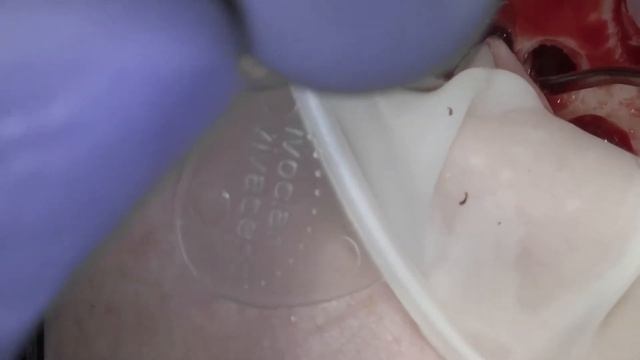 синуслифтинг КОСТНАЯ ПЛАСТИКА на в/ч смотреть онлайн